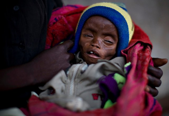 14-luni-yabila-kubemboli-malnourished-after-his-mother-fled-attacks-on-her-village-by-ugandan-lords-resistance-army-rebels